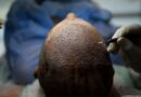 How Turkey Hacked the Hair Transplant Industry