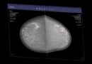 AI Can Now Clear Some Mammograms Without a Radiologist’s Review